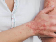 Doce municipios mexicanos en alerta por lepra