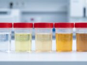 Colores de la orina y su significado para tu salud Descubre cómo el color de la orina puede revelar información importante sobre tu salud y cuándo deberías consultar al médico.